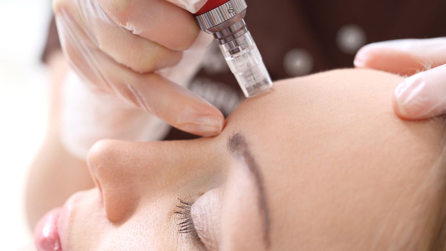 Microneedling: Alles, was du über die Beauty-Behandlung wissen musst