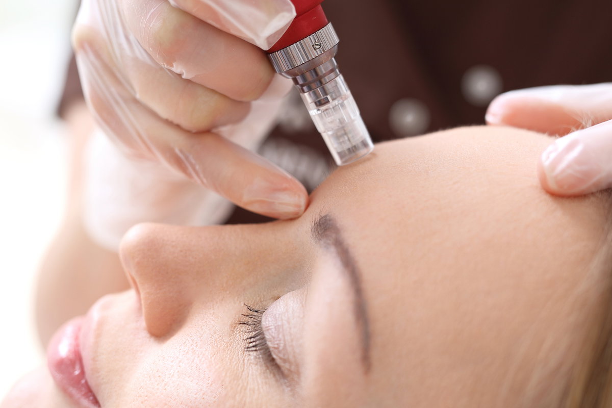 Frau bekommt eine Dermapen Anwendung
