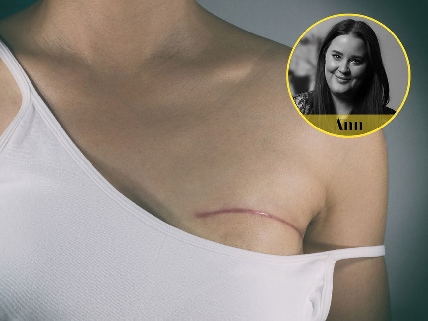 Brustkrebs: Narbe nach Mastektomie