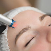 Anti-Akne Laser: Alles, was du über die Behandlung wissen musst – laut Dermatologe
