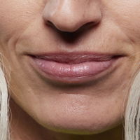 Marionettenfalte was hilft: So reduzierst du die Linien