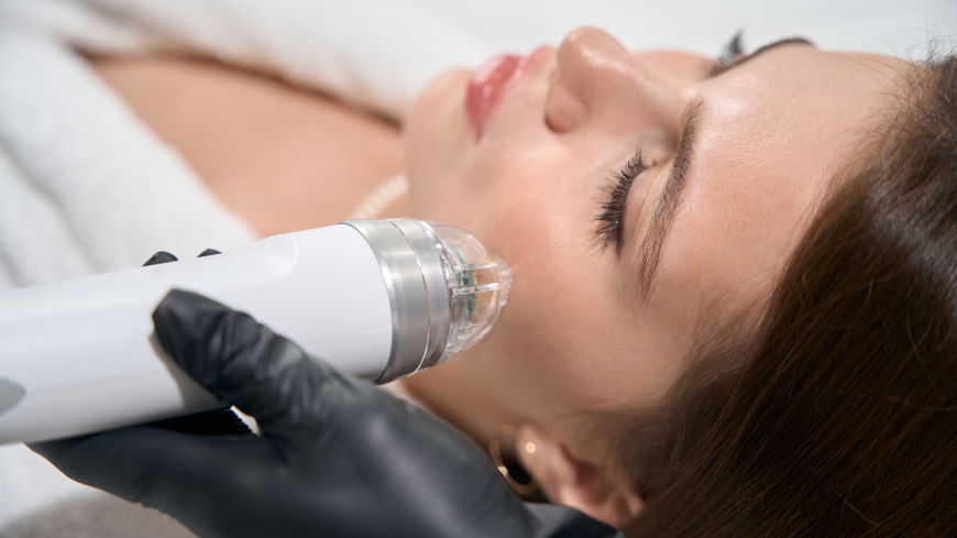 Mein Erlebnis mit Radiofrequenz-Microneedling bei Dr. Eveline Urselmann