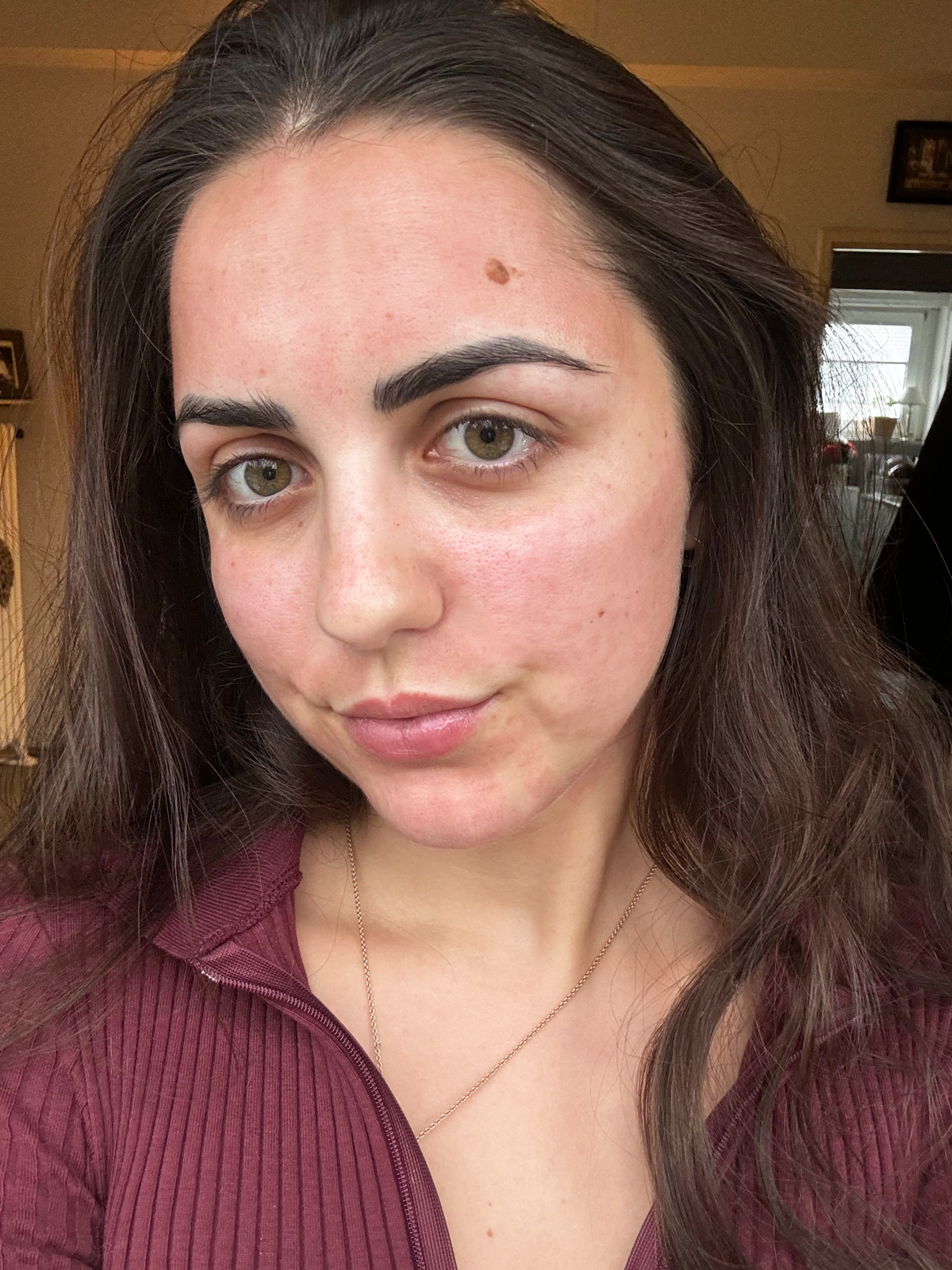 Radiofrequenz-Microneedling