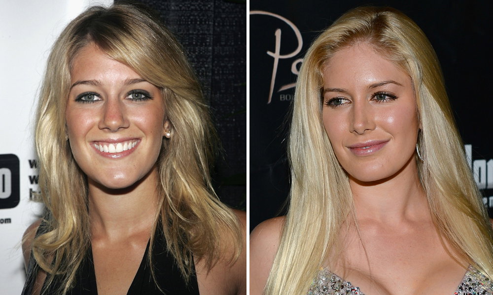 Heidi Montag vor und nach Schönheits-OP