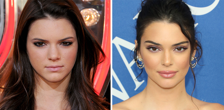 Kendall Jenners Gesicht vor und nach OPs