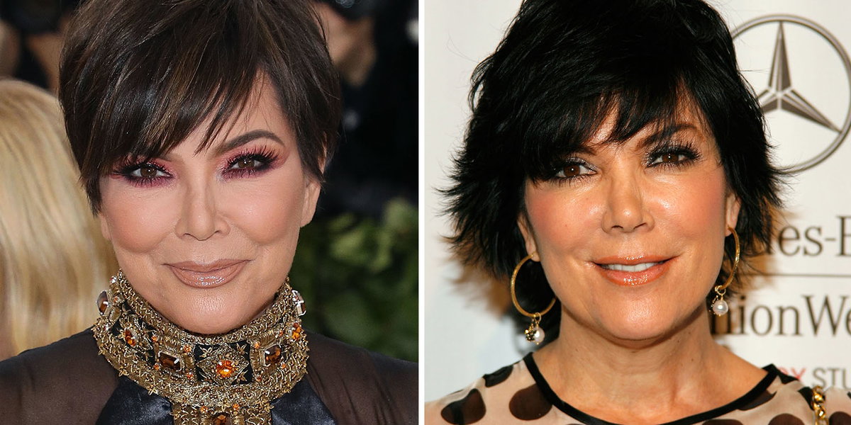 Kris Jenners Gesicht vor und nach OPs