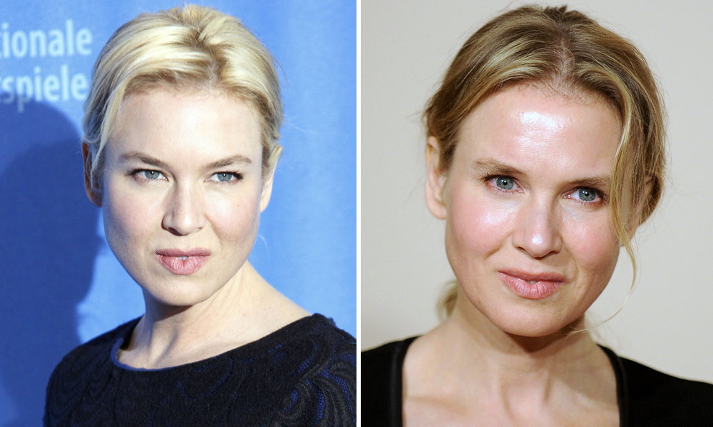 Renée Zwellweger vor und nach Beauty-Eingriff
