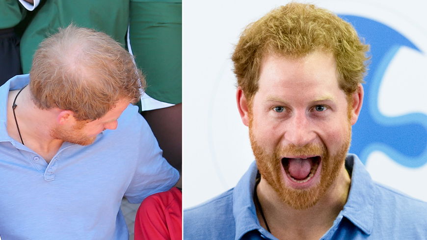 Aaaah! Prinz Harry verliert jetzt auch seine Haare